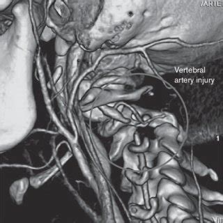 (PDF) Craniocervical spinal instability after type 1 Arnold Chiari ...