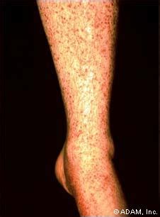 Diseases Treatment: Vasculitis Treatment