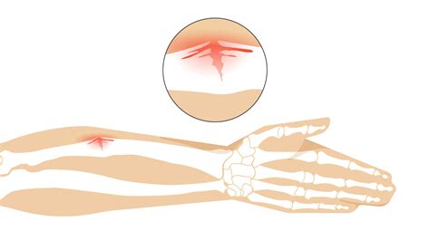 Greenstick Fracture: Symptoms, Causes, and More