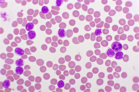 Chronic Lymphocytic Leukemia Patient