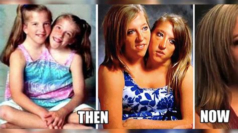 What Conjoined Twins Abby And Brittany Hensel Look Like Now