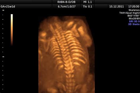 Sonogram vs Ultrasound - Difference and Comparison | Diffen