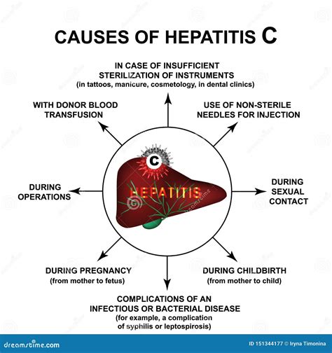 Causes of Hepatitis C. World Hepatitis Day. Infographics. Vector ...