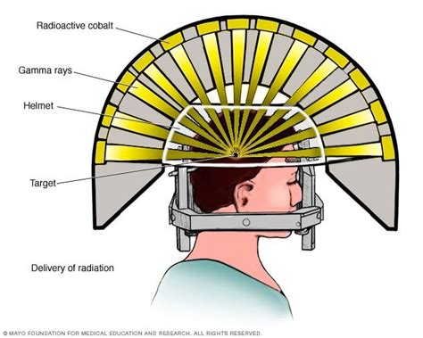 Stereotactic radiosurgery - Mayo Clinic in 2021 | Radiation therapy ...