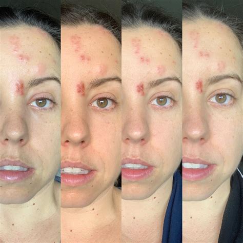 [33/f] Day 5 - 8 of Face Shingles : r/shingles