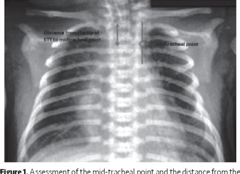 Endotracheal Tube Placement X Ray