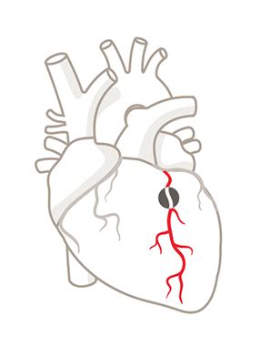 heart attack clip art 10 free Cliparts | Download images on Clipground 2024