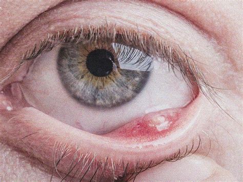 Stye inside eyelid (internal stye): How to identify, and treatments