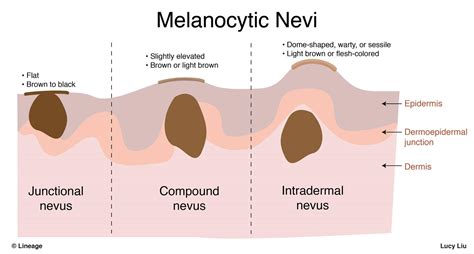 Congenital Melanocytic Nevus Compound Type