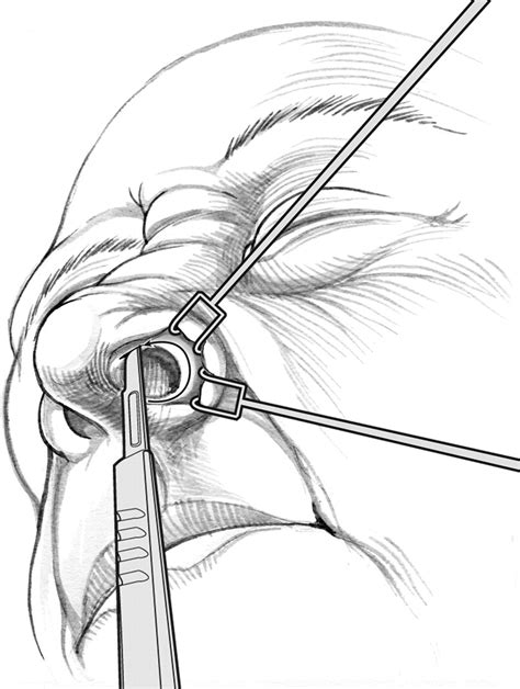 Facial degloving approach to the midface - Operative Techniques in ...