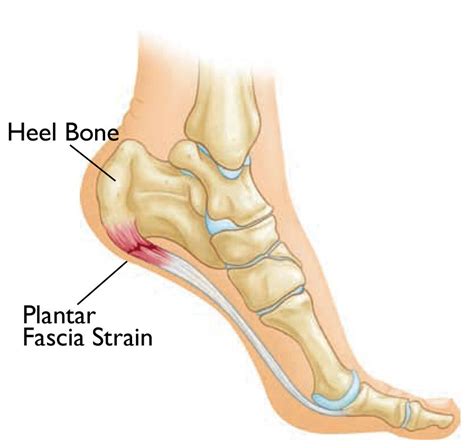 Plantar Fasciitis and Bone Spurs - OrthoInfo - AAOS