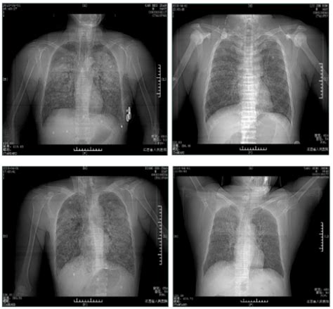 Management of Phosgene-Induced Acute Lung Injury (ALI) by Personalized ...