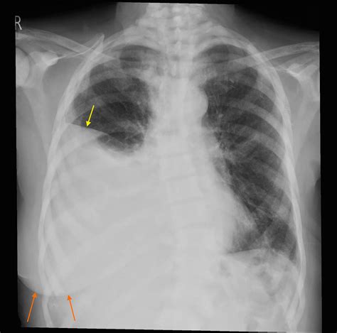 Malignant pleural effusion (2) - Radiology at St. Vincent's University ...