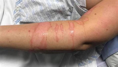 Nurse left with second-degree burns after patient attacks her with ...