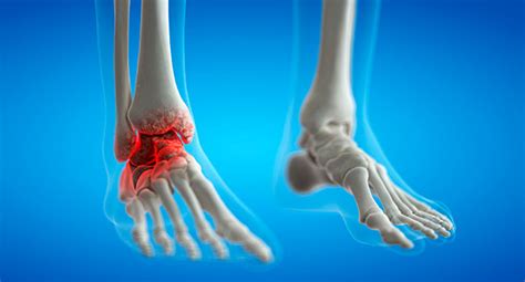 Arthritis of the foot and ankle | Orthopaedics WA