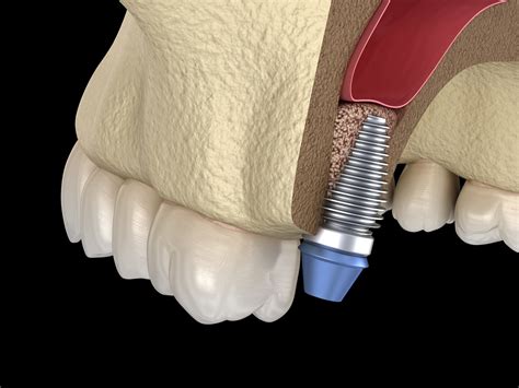 Recovering from Your Dental Bone Graft Procedure