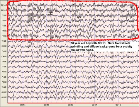 Beta Waves - Scottsdale Neurofeedback Institute, AZ