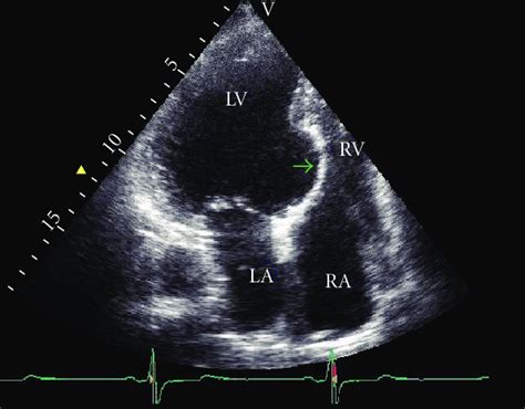 Transthoracic echocardiographic image of left ventricular septal ...