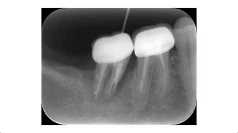 Periapical Abscess Radiograph