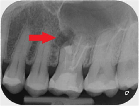 Periapical Abscess Radiograph