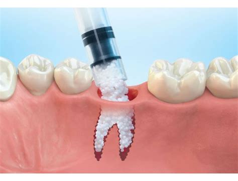 Bone Grafting - Parker Dental Group - Family Dentistry