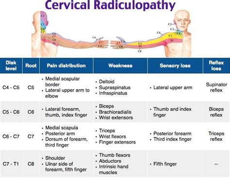 Facebook | Cervical radiculopathy, Radiculopathy, Cervical