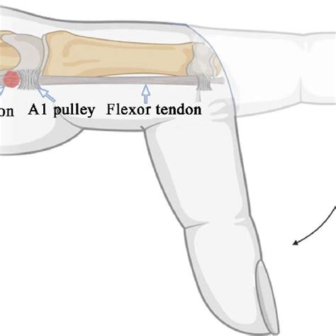 Finger with flexion locking due to flexor tendon swelling. | Download ...