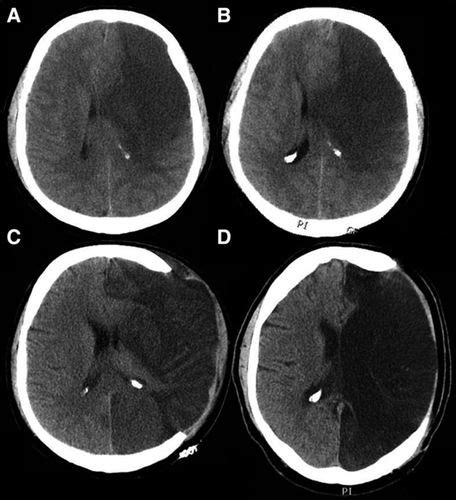 Malignant Hemispheric Infarction | Stroke