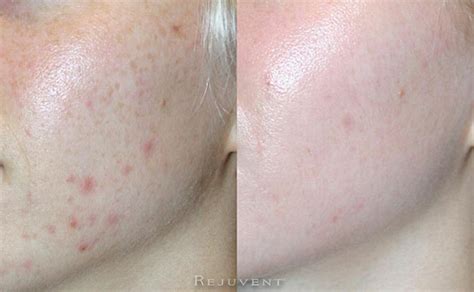 Acne / Hormonal Acne Photos • Rejuvent Medical Spa Scottsdale