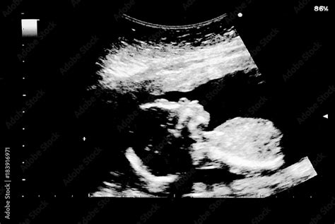 Ultrasound of baby in mother's womb. Stock Photo | Adobe Stock