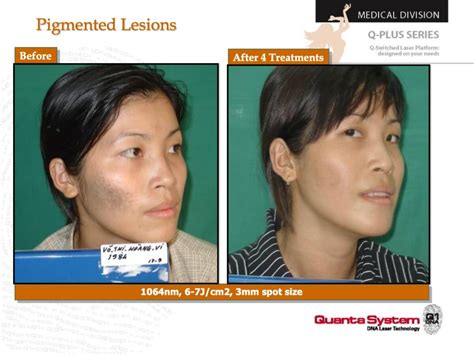 Melasma Treatment San Francisco: Cost, Risks, Before & After