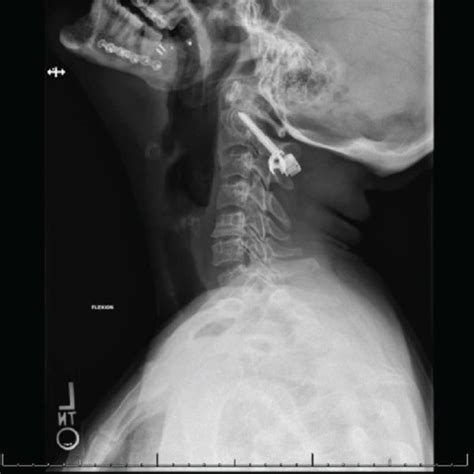 Fracture of C2 pedicles shown with white arrows. Sagittal view (a) and ...