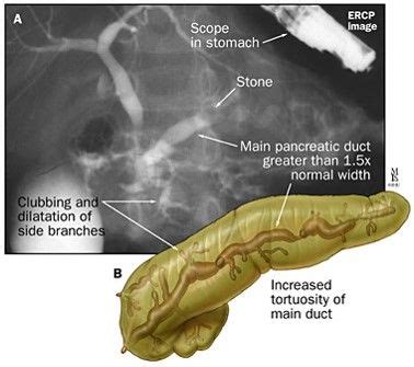 Mnemonic based management of Acute Pancreatitis | Epomedicine