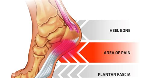 What’s the Difference Between Plantar Fasciitis and Heel Spurs ...