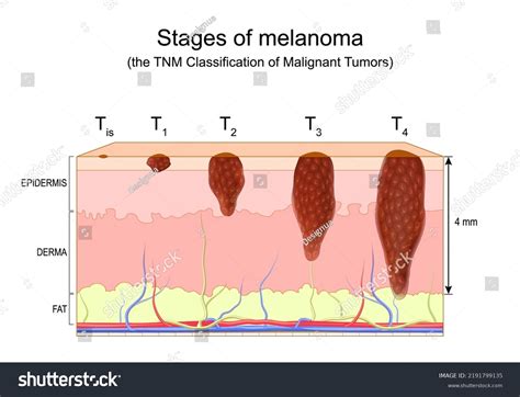 Melanoma Skin Cancer Stages