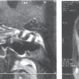 MRI with contrast dye showing filled out left-side para- | Download ...