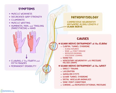 Ulnar Nerve Entrapment: What Is It, Symptoms | Osmosis