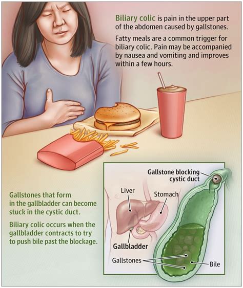 Gallstones and Biliary Colic | Medical surgical nursing, Pharmacology nursing, Medical knowledge