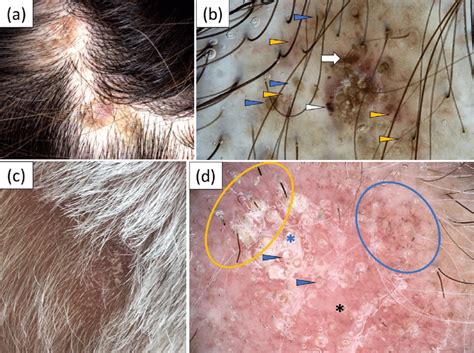 Hair And Scalp Changes In Cutaneous And Systemic Lupus, 50% OFF