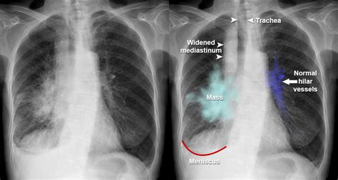 Lung Hilum