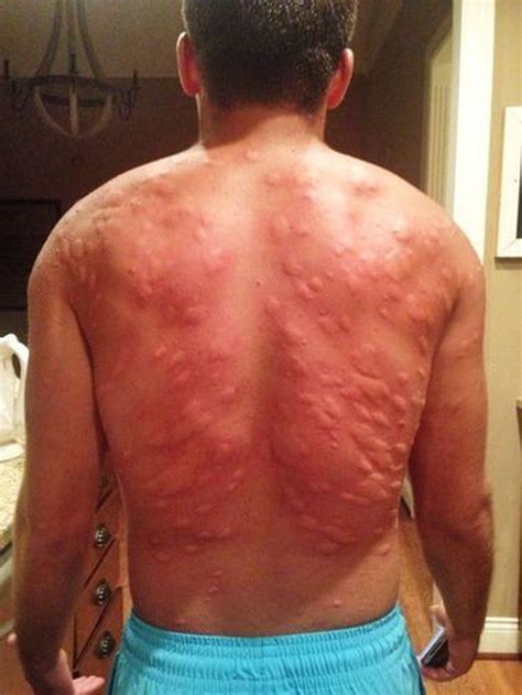 Ever wonder what dozens of mosquito bites look like? Here you go ...