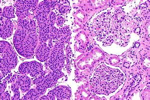 Renal oncocytoma - Libre Pathology