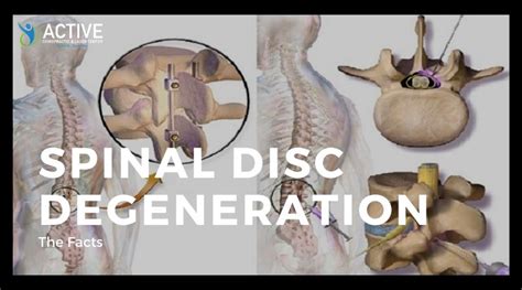 Chiropractic & Laser Therapy: Spinal Disc Degeneration: The Facts