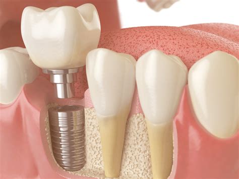 Bone Grafting for Dental Implants: What Is It and How Does It Work?