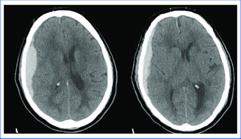 CT scan showing an acute subdural hematoma with mass effect and midline ...