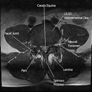 Facet Joint Syndrome - Complete Orthopedics & Podiatry | Multiple NY ...