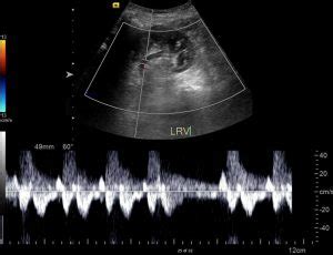 Renal Vein Thrombosis: Presentation, Causes and Treatment