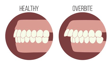 How to fix overbite - alernasge