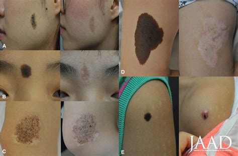 Congenital Melanocytic Nevus Removal