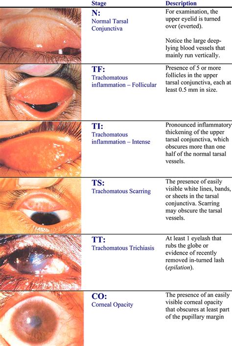 Trachoma - Causes and Treatment